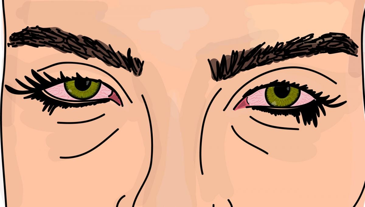 Puffy red eyes are caused by the vasodilation effect of marijuana.